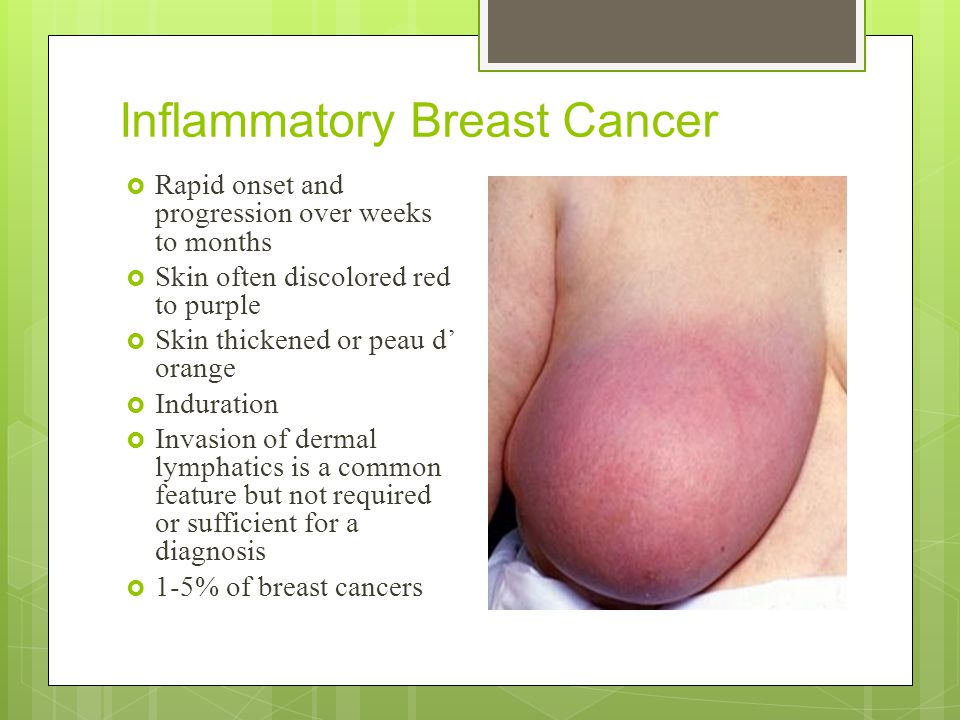 breast ca inflammatory
